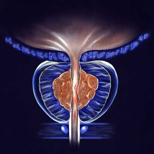 Cross-section illustration of stage 2 benign prostatic hyperplasia