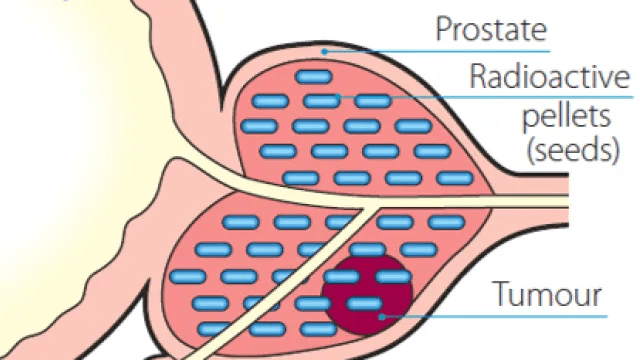 Diagram of brachytherapy seeds placed throughout the prostate to treat the tumor