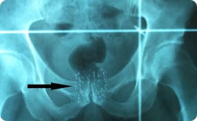Pelvic X-ray showing radioactive brachytherapy seeds implanted in the prostate