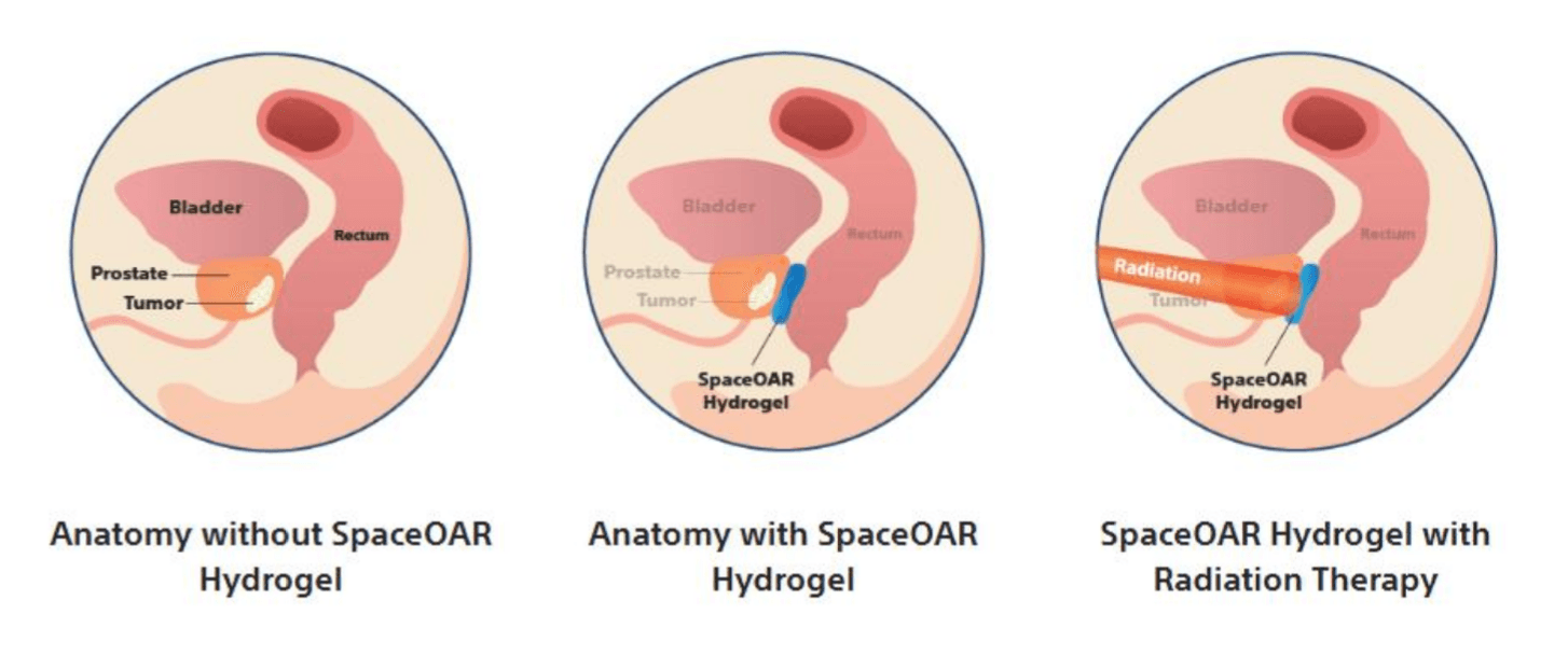 Diagram showing anatomy without SpaceOAR hydrogel, anatomy with SpaceOAR hydrogel, and SpaceOAR hydrogel with radiation therapy