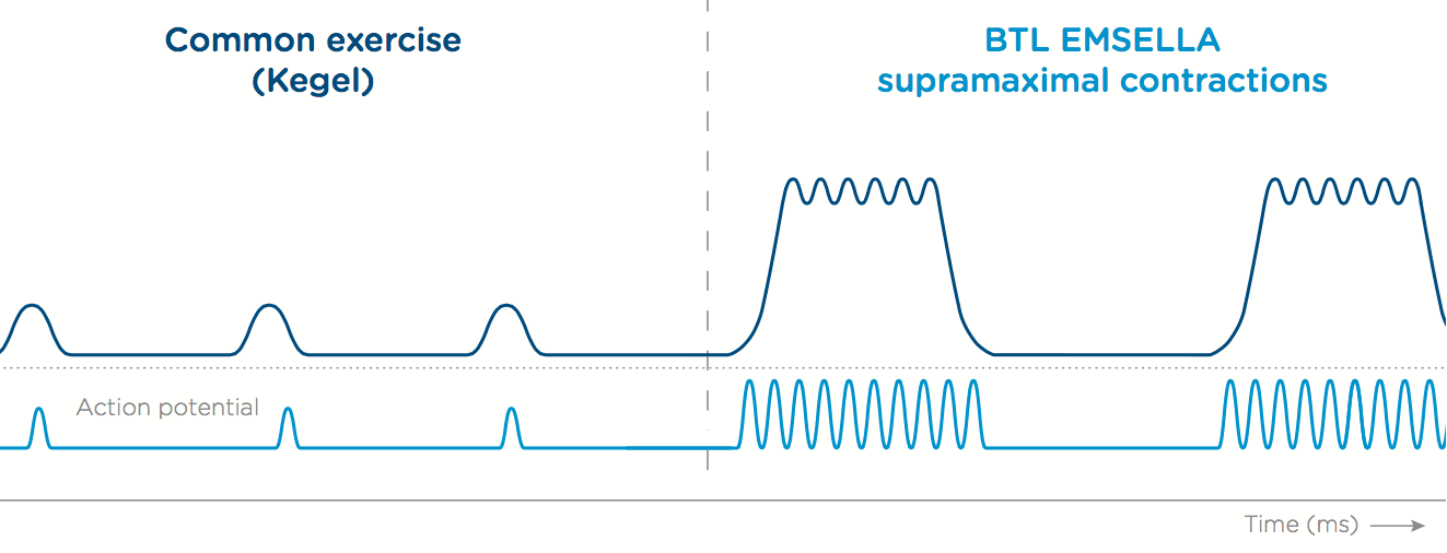 Diagram: pelvic floor before EMSELLA treatment, during electromagnetic stimulation, and after improved support and bladder control