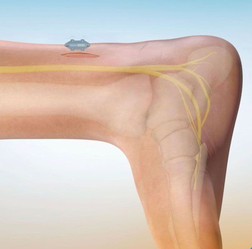 Illustration of implant placement above the ankle