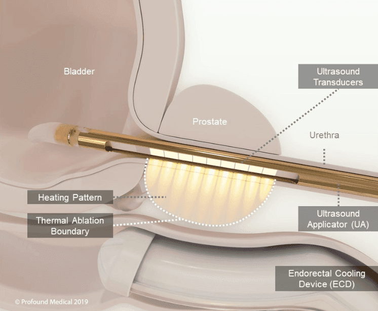 Diagram of the TULSA-PRO procedure showing ultrasound applicator and thermal ablation of the prostate
