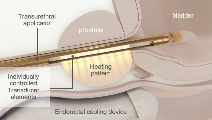Diagram of the TULSA procedure: transurethral applicator, prostate, bladder, heating pattern, and endorectal cooling device