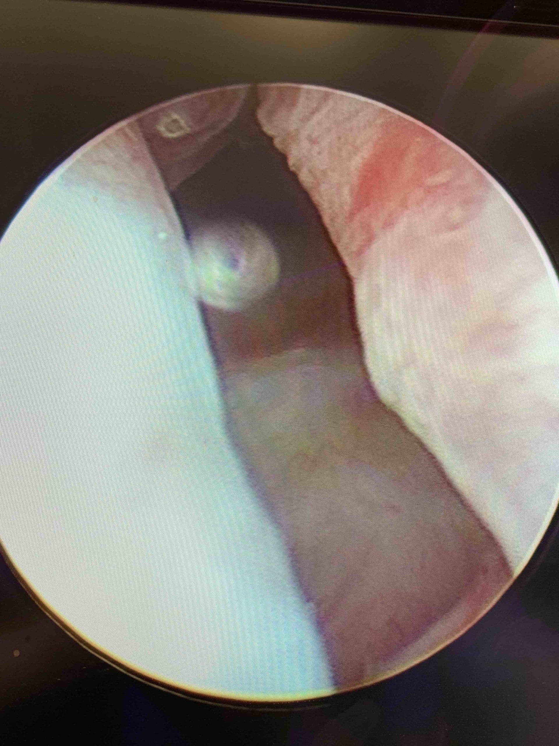 Endoscopic view after UroLift: open passage with implants holding tissue