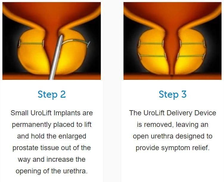 Medical illustrations: UroLift implants placed in the prostate, and open urethra after device removal