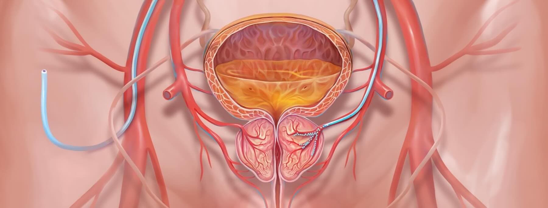 Illustration of the prostate artery embolization procedure