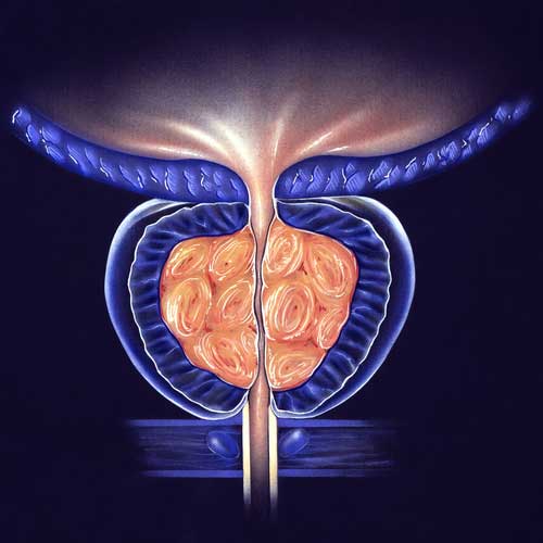 bpc 157 and enlarged prostate Benign Prostatic Hypertrophy (BPH) enlargement South West Sydney Urology BPH Enlarged Prostate Treatment |